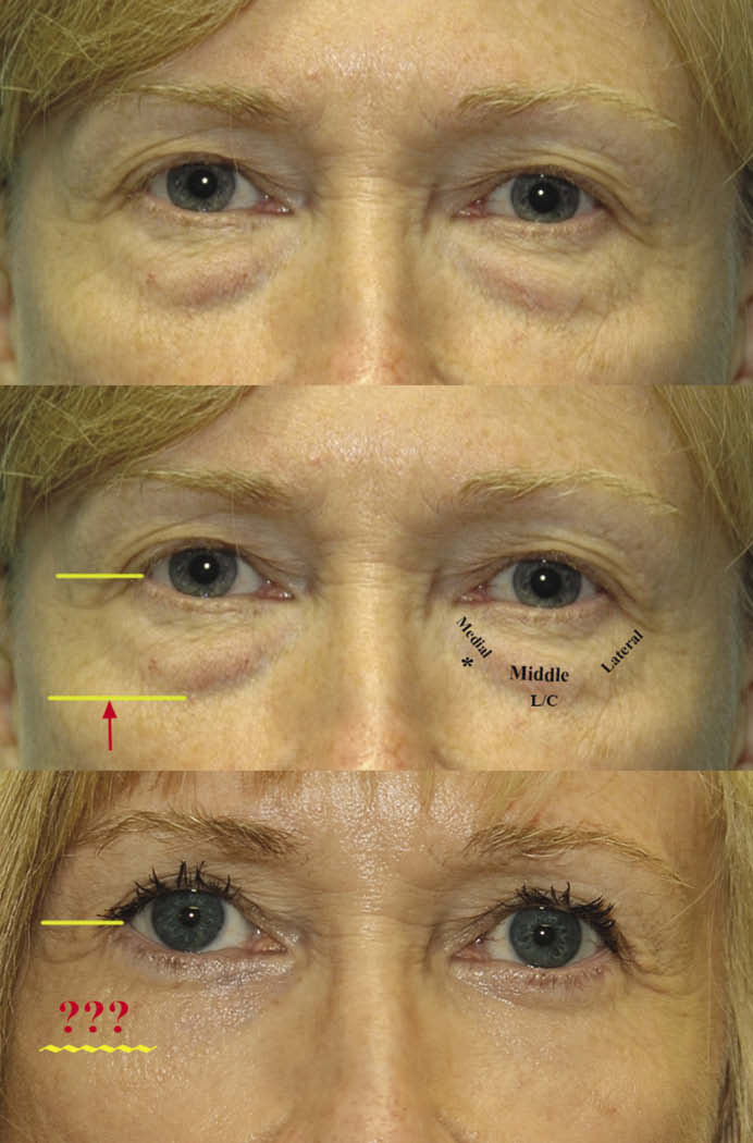 Before and after of eyelid surgery for the lower eyelid with fat repositioning only