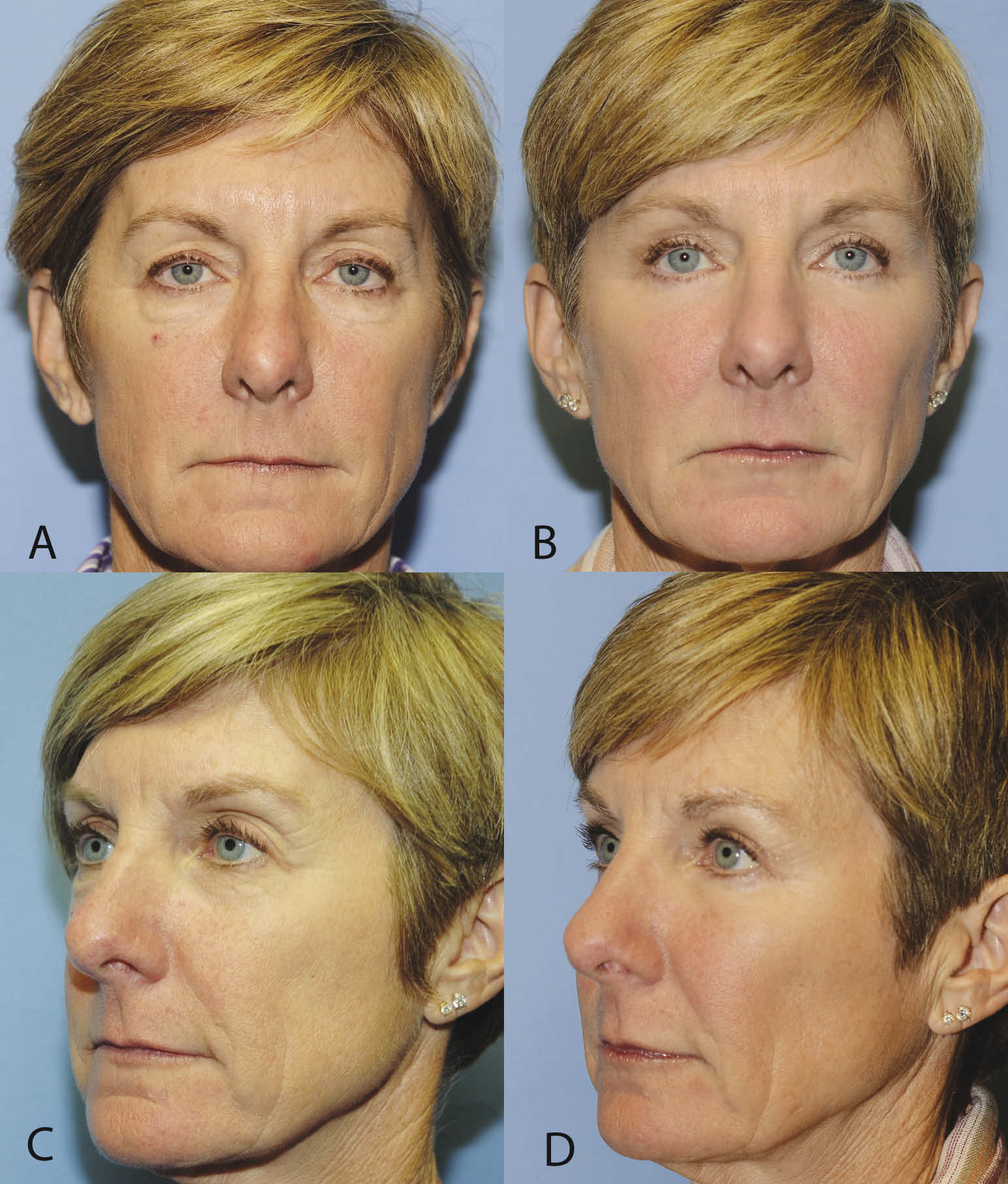 10-month result. Upper and lower blepharoplasty with fat repositioning and augmentation