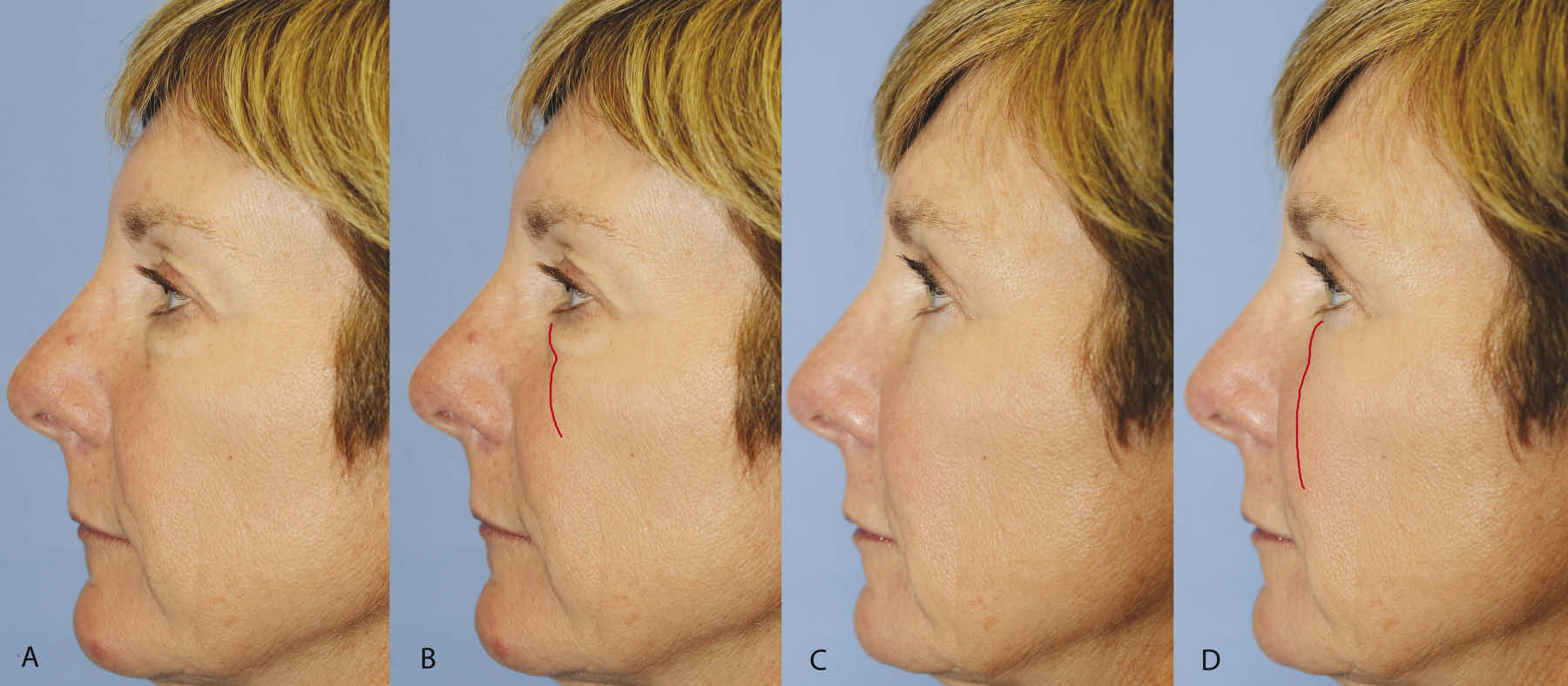 Upper and lower blepharoplasty with fat repositioning and augmentation