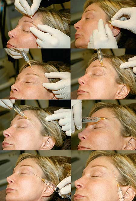 Demonstration of injecting a hyaluronic acid filler into a woman's temple