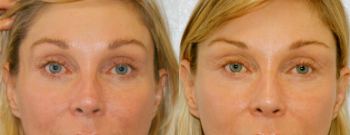 Before-and-after result with diluted hyaluronic acid in woman's face