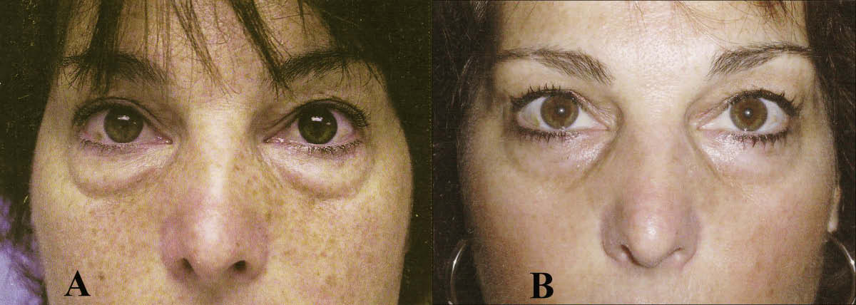 One-year result by another surgeon using subtractive blepharoplasty techniques