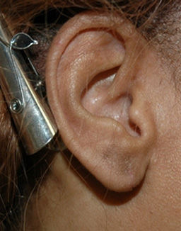 Ear Surgery Before and After category