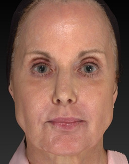 Laser Skin Rejuvenation Before and After 03