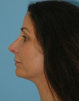 Rhinoplasty Before and After 03