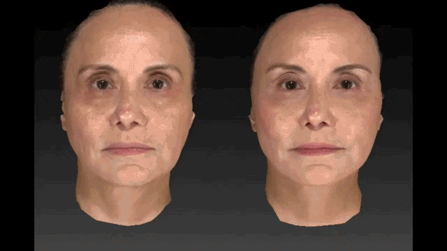 3D Image Of Patient before and after a facelift in Orange County