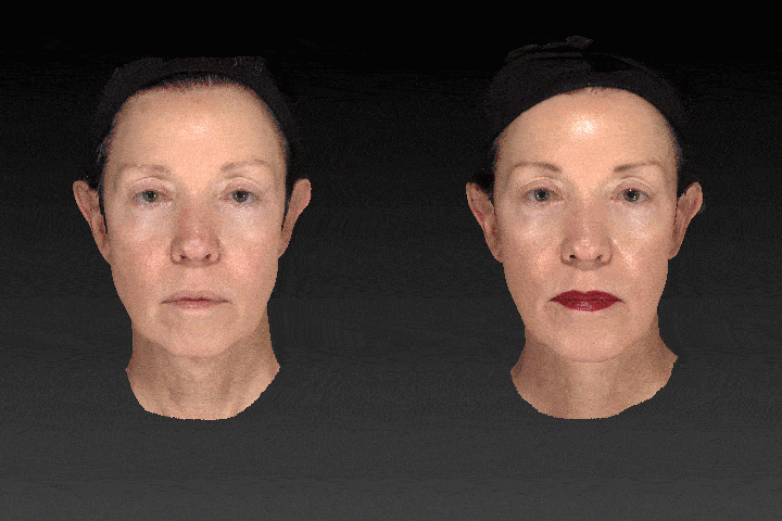 Vectra imaging of a woman's face