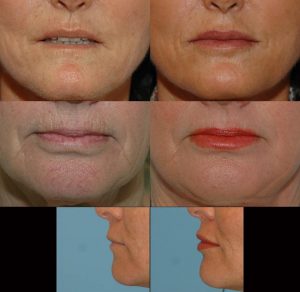 Erasing Lip Lines and Wrinkles - Refreshed Aesthetic Surgery Blog