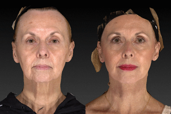 facelift before and after animation