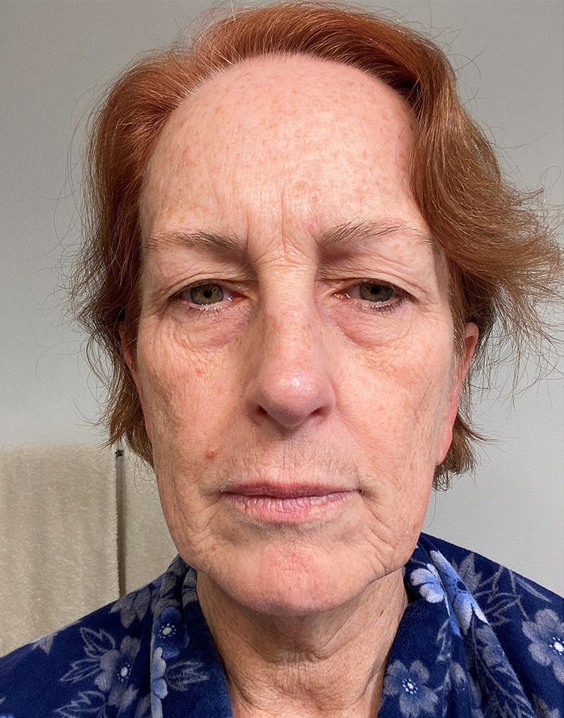 Before photo of an Orange County facelift patient