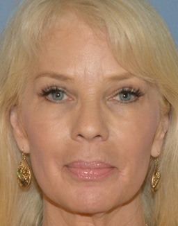 Blepharoplasty Before and After 03