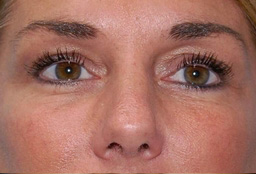 After blepharoplasty in Newport Beach