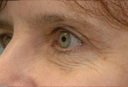 Eyelid Surgery Orange County