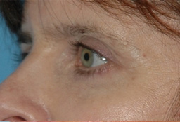 After eyelid surgery in Orange County