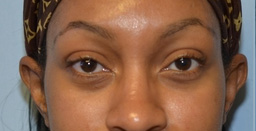 Blepharoplasty Before and After 09