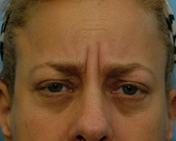 Botox Before and After 02