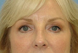 Brow Lift Before and After 01