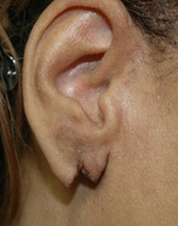Ear Surgery Before and After 02