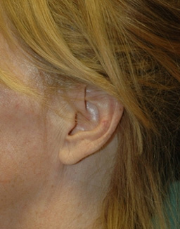 Facelift Incisions Before and After 01