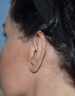 Facelift Incisions Before and After 01