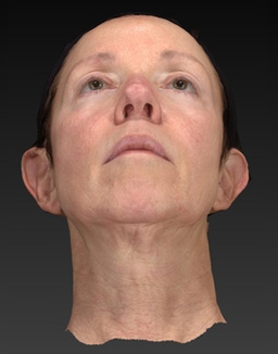 Facelift Incisions Before and After 02