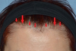 Facelift Incisions Before and After 03