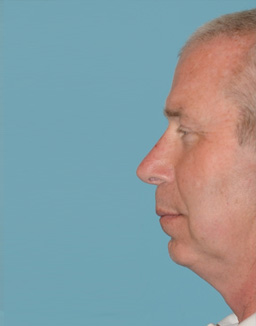 Facial Implants Before and After 01