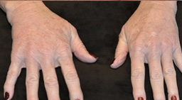 Hand Rejuvenation Before and After 01