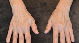 Hand Rejuvenation Before and After 02