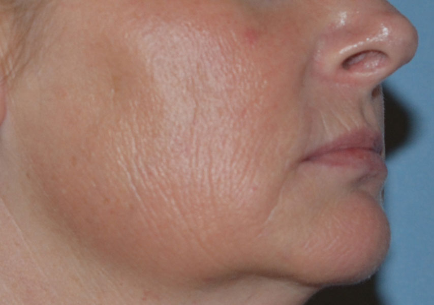 Laser Skin Rejuvenation Before and After 04