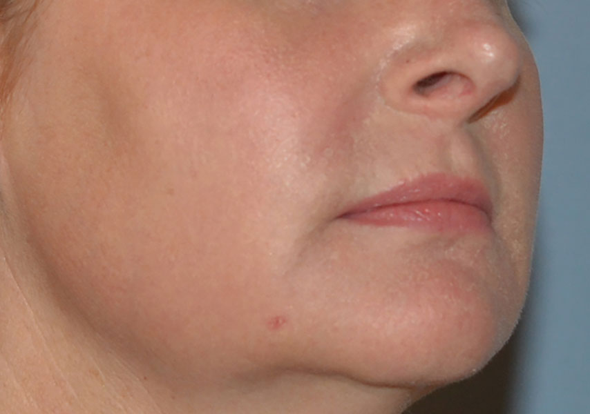 Laser Skin Rejuvenation Before and After 01