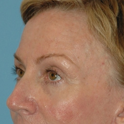 Laser Skin Rejuvenation Before and After 13