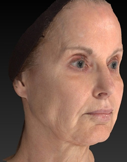 Laser Skin Rejuvenation Before and After 17