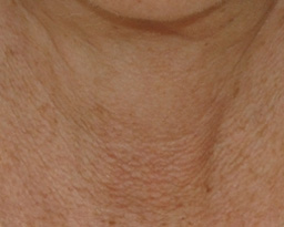 Laser Skin Rejuvenation Before and After 08