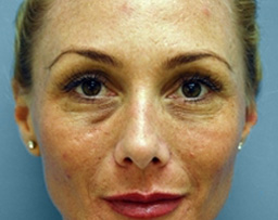 Laser Skin Rejuvenation Before and After 19