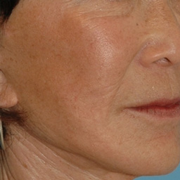 Laser Skin Rejuvenation Before and After 12