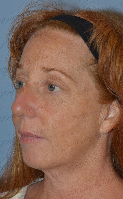 Laser Skin Rejuvenation Before and After 23