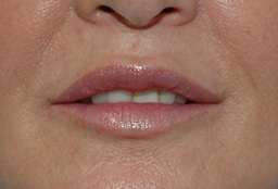 Lip Augmentation Before and After 01