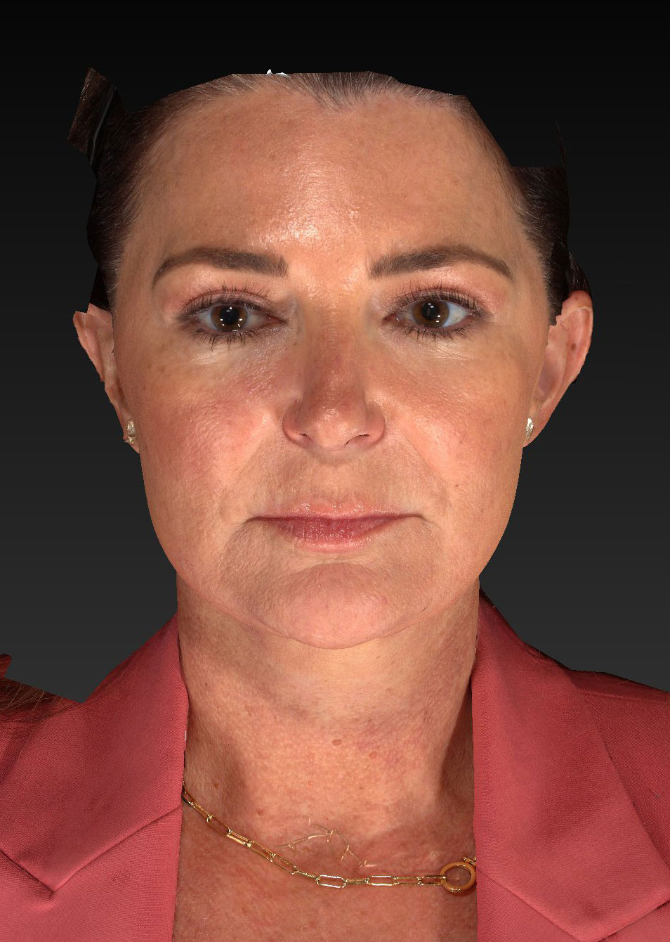 Facelift: Lower Face And Neck Lift Before and After 08