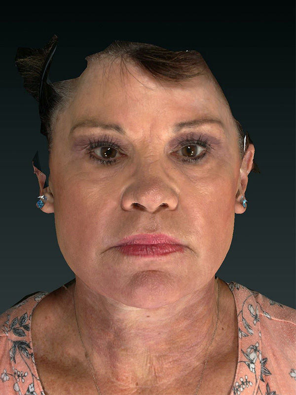 Facelift: Lower Face And Neck Lift Before and After 18