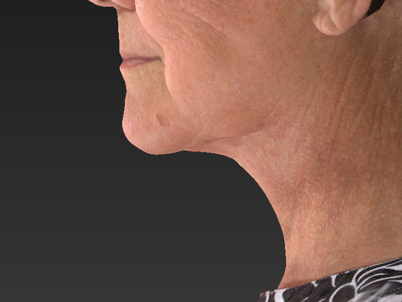 Facelift: Lower Face And Neck Lift Before and After 05