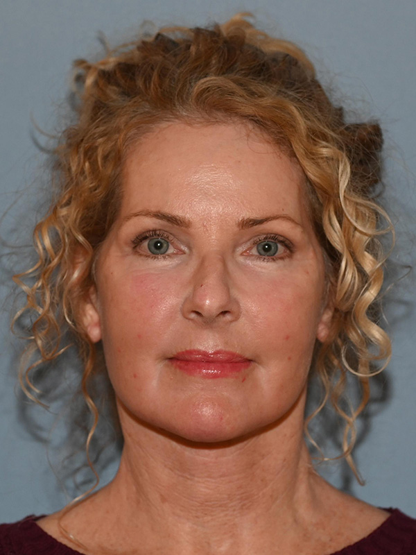 Facelift: Lower Face And Neck Lift Before and After 19