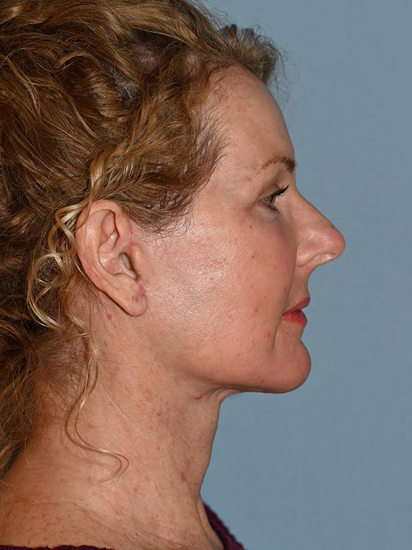 Facelift: Lower Face And Neck Lift Before and After 06