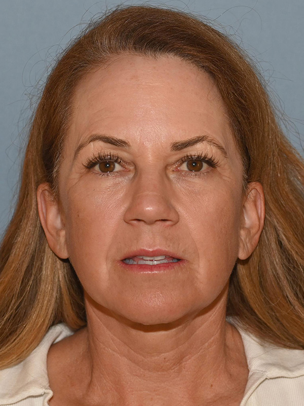 Facelift: Lower Face And Neck Lift Before and After 22