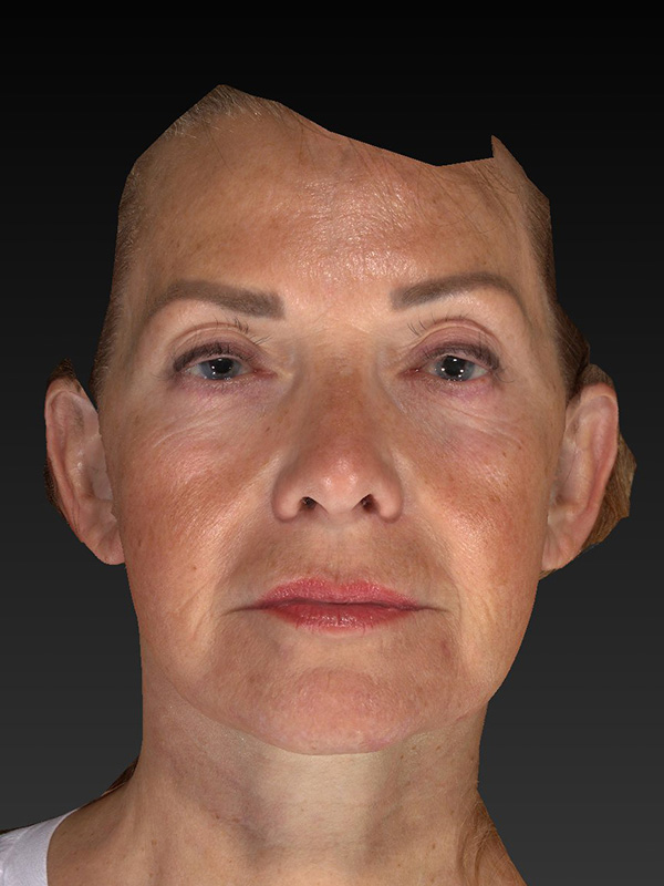 Facelift: Lower Face And Neck Lift Before and After 11