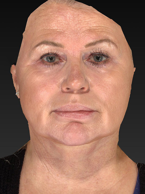 Facelift: Lower Face And Neck Lift Before and After 04