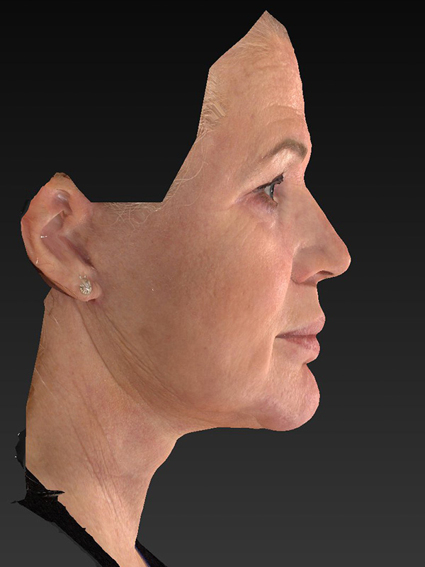 Facelift: Lower Face And Neck Lift Before and After 10