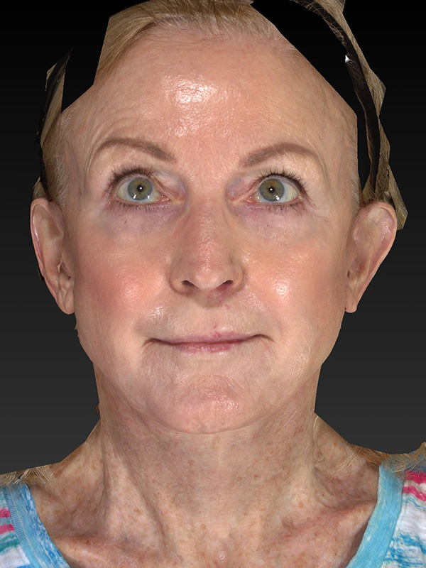 Facelift: Lower Face And Neck Lift Before and After 24
