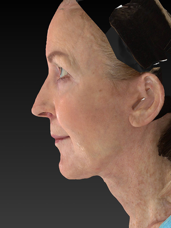 Facelift: Lower Face And Neck Lift Before and After 11