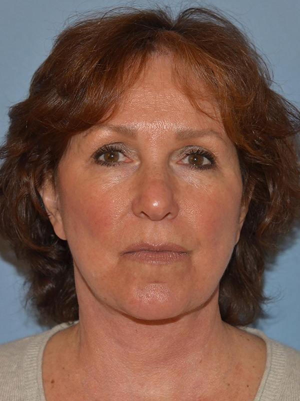 Facelift: Lower Face And Neck Lift Before and After 01